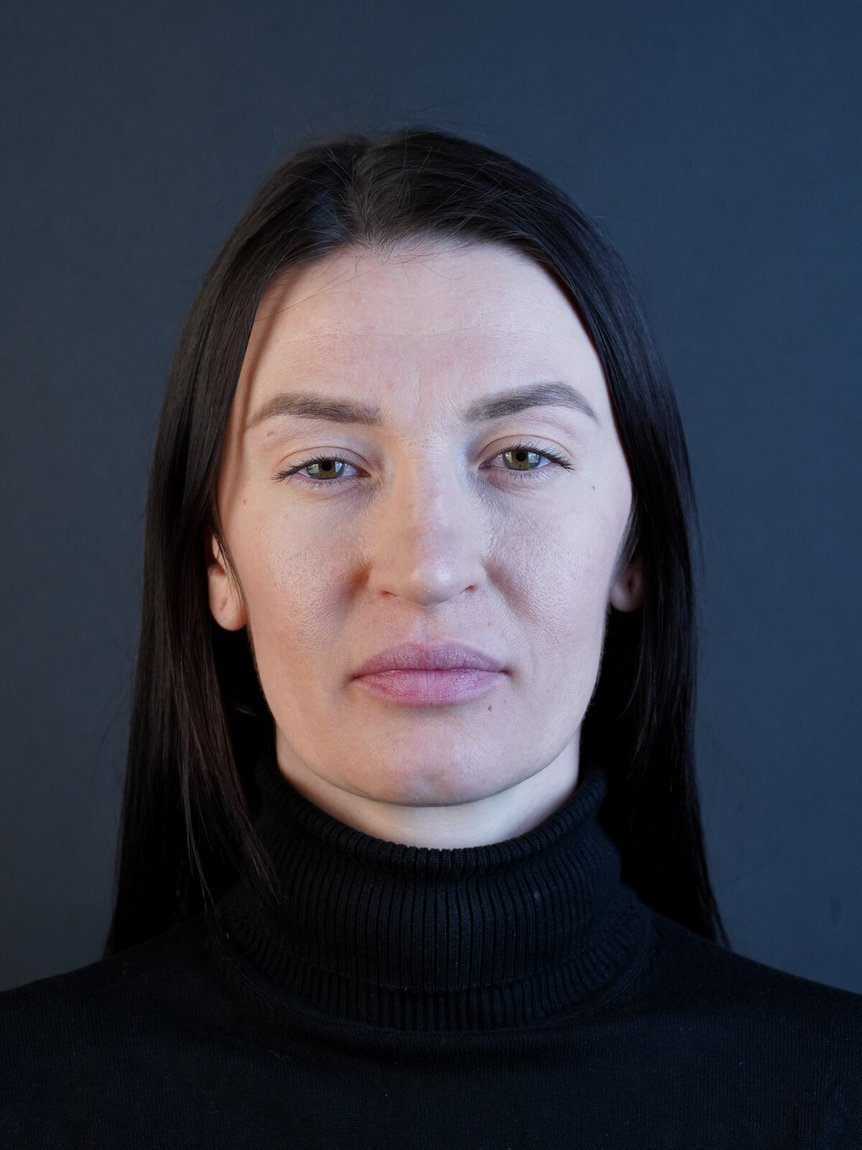 Кругова блефаропластика — фото до операції
